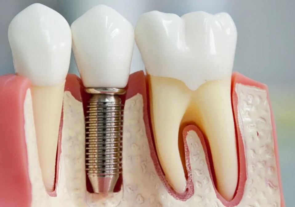 Удаление имплантов зубов