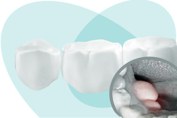 Удаление экзостозы зуба